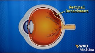 Detached Retina Vitrectomy with Scleral Buckle [upl. by Files234]