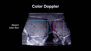 Diagnosing testicular torsion [upl. by Inalej]