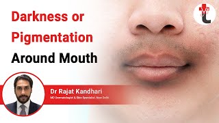 Darkness or Pigmentation Around Mouth  Darkening Around Mouth Causes  Treatment  Dermatologist [upl. by Galven87]