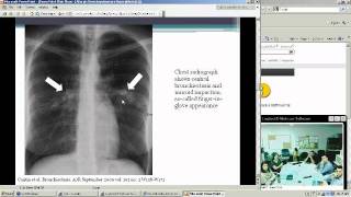 Allergic Bronchopulmonary Aspergillosis Heather Doss MD [upl. by Enirehtahc108]