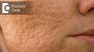 How to remove Acne scars by natural remedies  Dr Chetali Samant [upl. by Esserac]