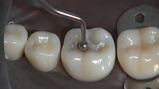 Class I Amalgam Preparation amp Restoration  Operative Dentistry [upl. by Anelas770]