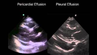 Cardiac Ultrasound Pericardial vs Pleural effusion [upl. by Giordano]