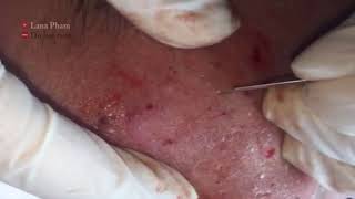 Eps 01 How to Remove Infected Blackheads amp Whiteheads  LANA PHAM [upl. by Moore]