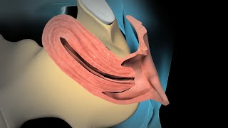 Dilation and Curettage D amp C [upl. by Enelrahs]