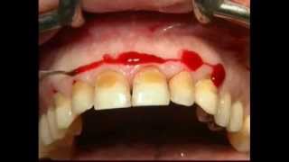 Gingival Surgery  External Bevel [upl. by Hertberg115]