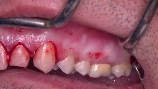 Gummy Smile Correction Surgery Dr Elie Maalouf [upl. by Anav13]