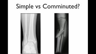 How to describe a fracture [upl. by Irb434]