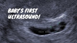 Babys First Ultrasound 6 Weeks Pregnant [upl. by Iclehc953]