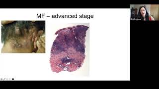 Pathology Grand Rounds  Cutaneous TCell Lymphoma  Dr Michi Shinohara [upl. by Eziechiele813]