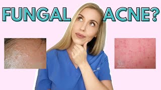 Do YOU have Fungal Acne  Dermatologist Talks Symptoms and Treatments [upl. by Vasta380]