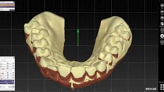 EXOCAD  Gingiva reduction guide design [upl. by Ecila]