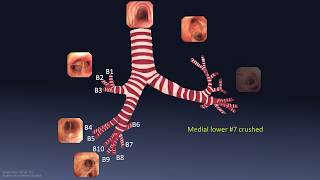 Using a Bronchial Scope for a Bronchoscopy at Christian Hospital in St Louis Missouri [upl. by Rosalba]