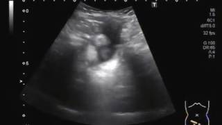 Ultrasound Video showing Hepatomegaly with liver approaching  kissing  the spleen [upl. by Areval]