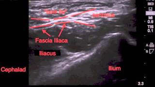 Ultrasound Guided Fascia Illiaca Block Tutorial  SSRAUSAcom [upl. by Uthrop]