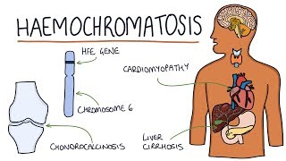 Understanding Haemochromatosis [upl. by Anilatac]