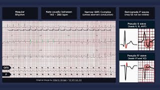 Atrioventricular Nodal Reentry Tachycardia AVNRT ECG [upl. by Isiahi]