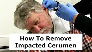 Removing Impacted Cerumen from a Patients Ear [upl. by Giana]