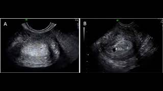 SACO GESTACIONAL ULTRASONIDO ecografia saco gestacional EMBARAZO PRIMER TRIMESTRE [upl. by Baiel182]