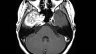 Chondrosarcoma [upl. by Naivaf844]