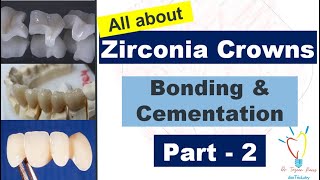 Zirconia Crowns  CEMENTATION vs BONDING [upl. by Ynnal]