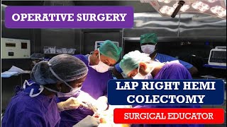 OPEN LEFT HEMICOLECTOMY STEP BY STEP Operative Surgery [upl. by Atteragram]