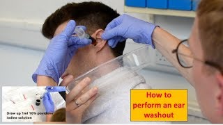 How to Perform an Ear Washout irrigation  ENTOtolaryngology Skills [upl. by Senilec]