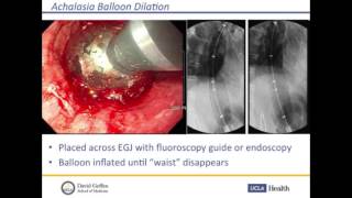 Pneumatic balloon dilation in achalasia [upl. by Zetnod754]