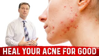 What Causes Pimples and How to Get Rid of Acne [upl. by Ninahs652]