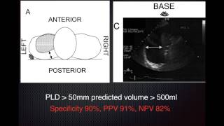 Estimate Pleural Effusion Volume [upl. by Sanford716]