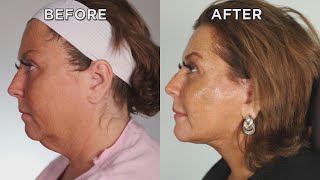 Watch Abby Lee Miller Get a Facelift While Awake [upl. by Ecirpac187]