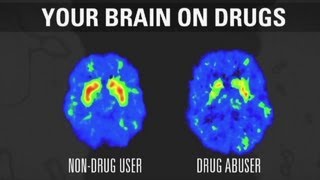 How addiction changes your brain [upl. by Rhyne]