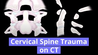 Cervical Spine Trauma on CT [upl. by Elmaleh957]