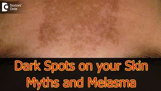 Dark Spots on your Skin  Hormones Vitamin D Melasma  Dr Aruna Prasad [upl. by Eleen]