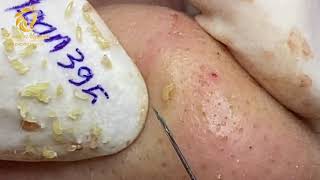 Treatment of blackheads and whiteheads 395  Loan Nguyen [upl. by Jeannine458]