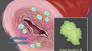 Treating GiantCell Arteritis [upl. by Hafital]