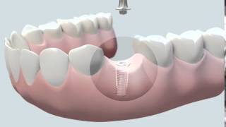 Cómo se coloca un implante dental [upl. by Mclain]