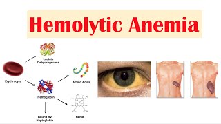 Hemolytic Anemia [upl. by Atteiluj]