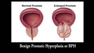 Dr Jared Moss Greenlight Laser for BPH [upl. by Ramoj]