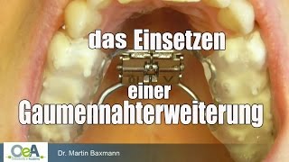 Gaumennahterweiterung einsetzen Rapid Maxillary Expansion I OeA [upl. by Aenitsirhc]