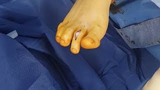 Surgical Correction of Hammertoe deformity [upl. by Nylirad506]