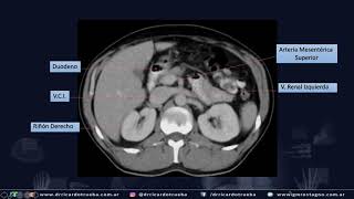 TOMOGRAFIA AXIAL BASICA DE ABDOMEN Y PELVIS [upl. by Beniamino982]