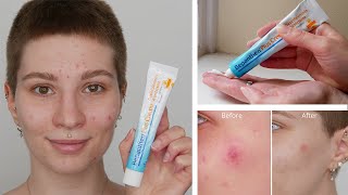 How to treat a minor burned wound with Bepanthen Plus Antiseptic Wound Healing Cream [upl. by Ruth755]