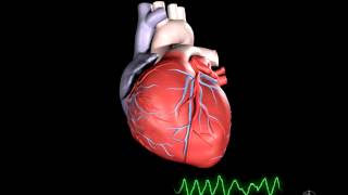 What is Ventricular Fibrillation [upl. by Malanie]