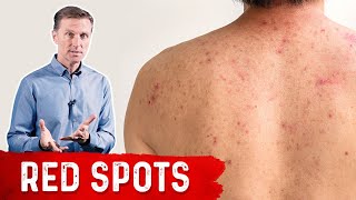 Why Red Spots on My Skin – DrBerg on Skin Red Spots Causes amp Remedies [upl. by Sadick]