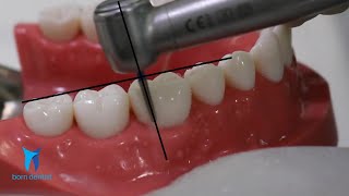 TOOTH PREPARATION FOR ZIRCONIA CROWN [upl. by Wiener857]