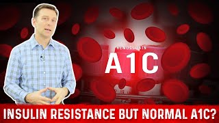 Normal A1C But Why Do I have Insulin Resistance – Dr Berg [upl. by Ennad]