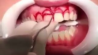 Gingivectomy amp Crown lengthening [upl. by Tadio]