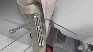 Tibial Tubercle Osteotomy [upl. by Vinay615]