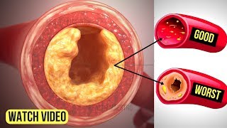 Just 3 Ingredients Will Unclog Your Arteries Without Medication and Reduce Cholesterol Fast [upl. by Onateyac540]